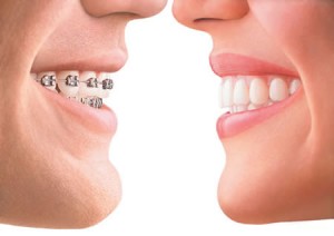 invisalign vs braces