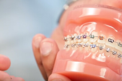 Help! What Do I Do About A Poking Wire? - Hamer & Glassick Orthodontics