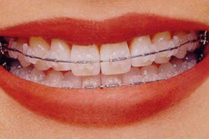 411 on adult orthodontic treatment