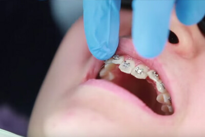 putting braces on bonding procedure