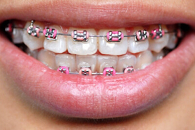 how to make your braces experience a success