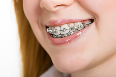 How to Correct an Overbite Retainer For Overbite Aura