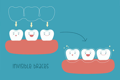 invisalign procedure 2