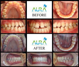 before and after braces Kainat