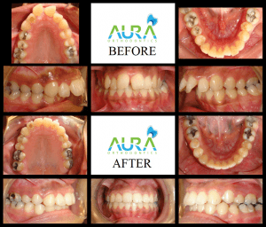 before and after braces Manisha