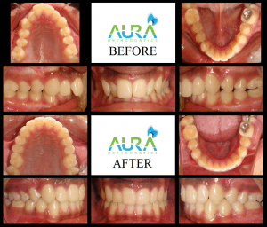 before and after braces Tanbir