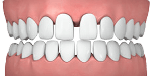common cases gapped teeth