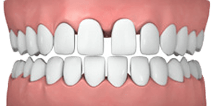 common cases gapped teeth