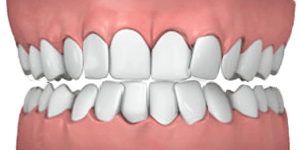 common cases overly crowded teeth