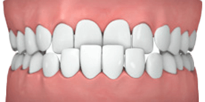 common cases underbite