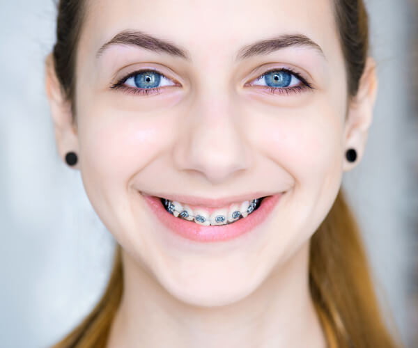 Types of Braces, Aura Orthodontics