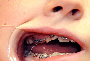 poking wire braces