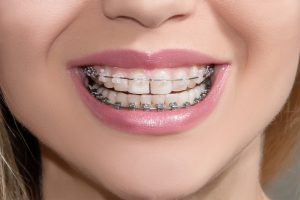 ceramic braces