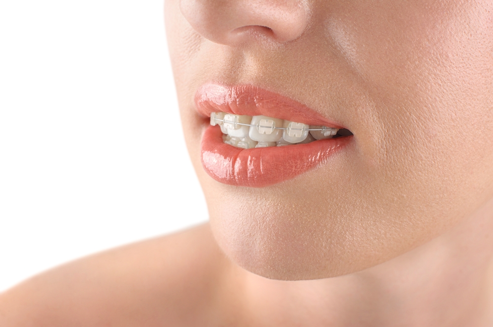 clear-braces-look-on-teeth