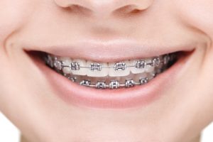 traditional braces