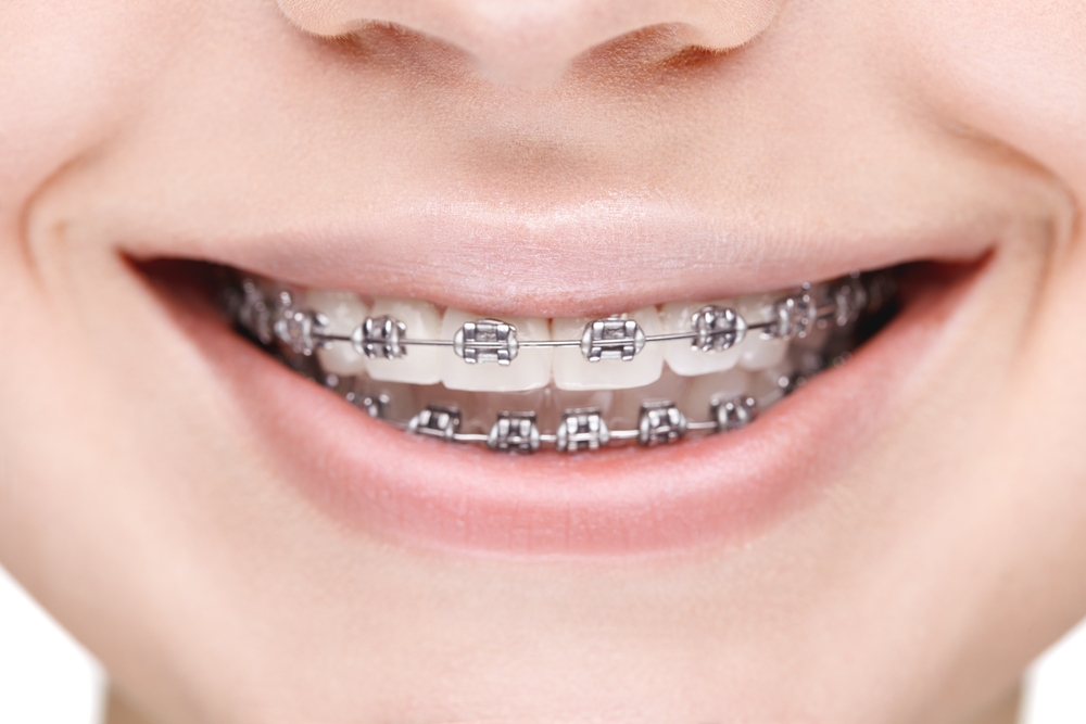 braces-forming-a-beautiful-smile