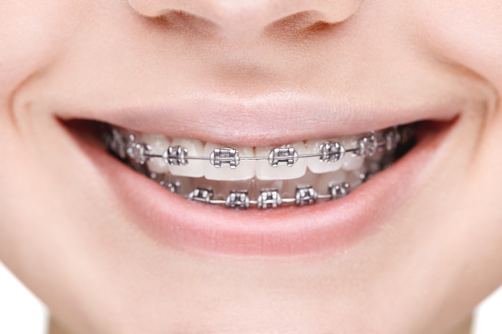 Braces vs. Invisalign: A Visual Guide to Your Orthodontic