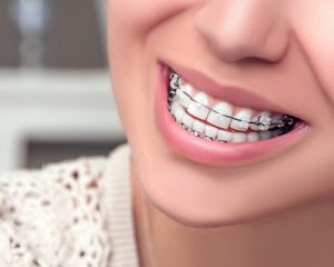 how to care for post braces teeth