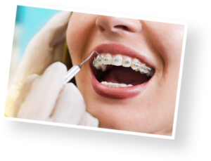 braces-cleaning-aura-orthodontics