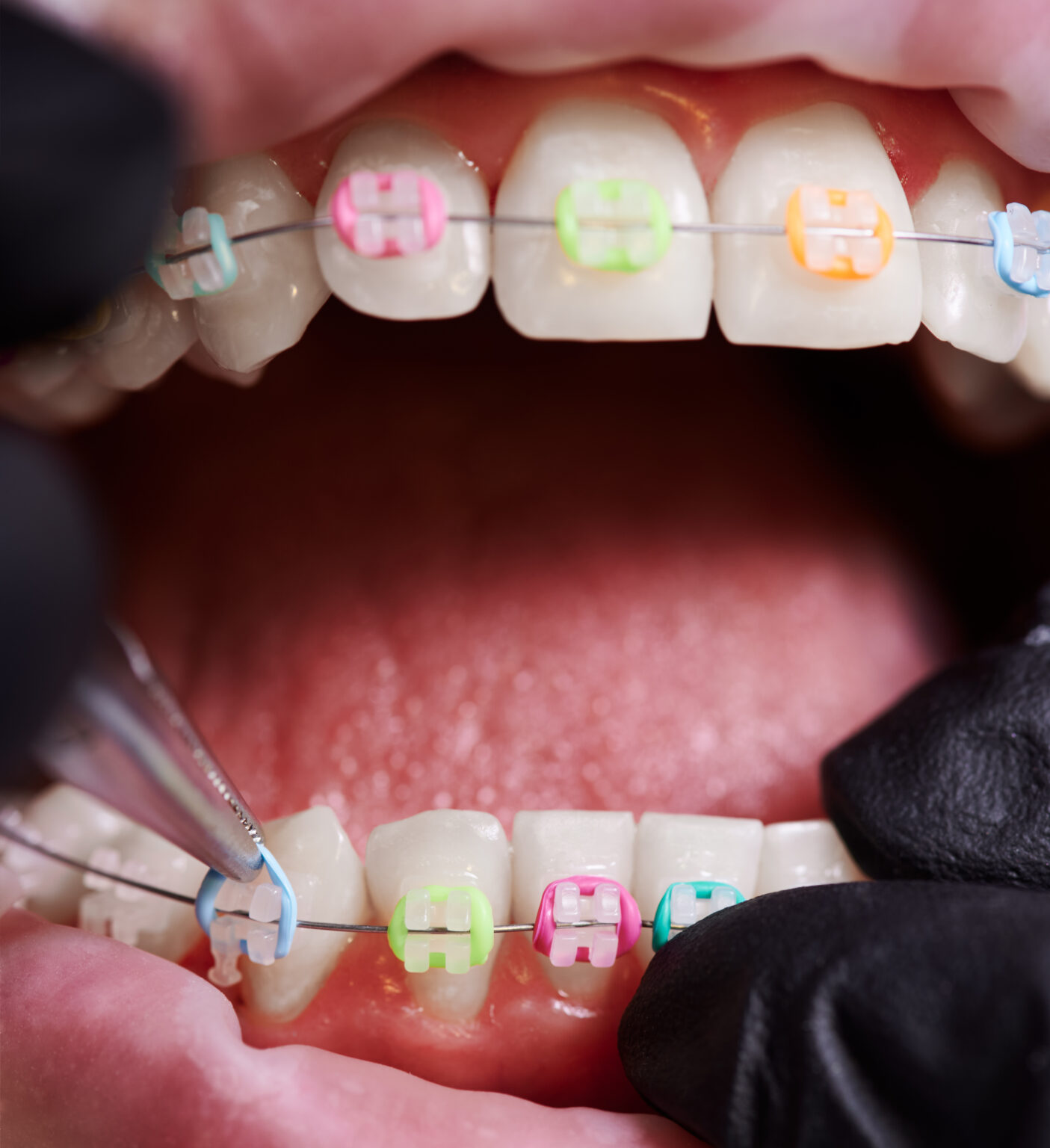 What Do Tthe Rubber Bands Do For Braces Aura Orthodontics